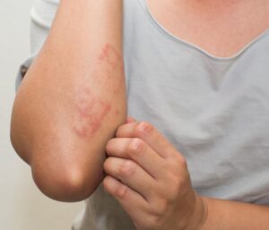 Skin Disorders